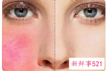 身体皮肤角质层薄怎么修复