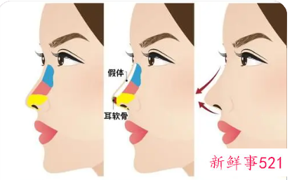 耳软骨隆鼻好不好