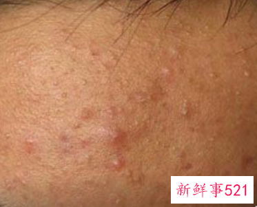 哪种痘痘是内分泌失调图片