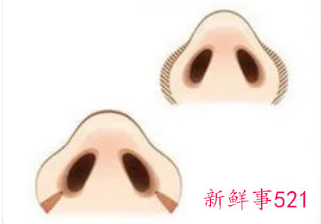如何使鼻翼变小