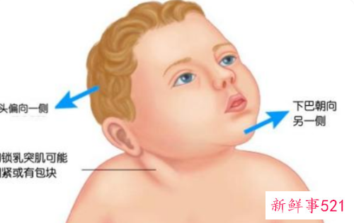 婴儿总往一边歪脖