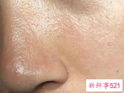 脸上出油有难闻的味道