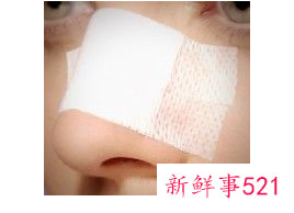 鼻子爱出油毛孔粗大有黑头