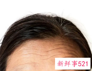 有什么办法消除抬头纹