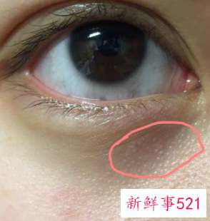 眼周围有脂肪粒怎么去除比较好