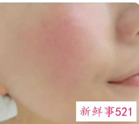 身体皮肤角质层薄怎么修复