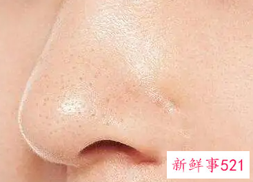 鼻子爱出油毛孔粗大有黑头