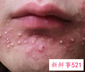 怎么才能不长痘痘粉刺