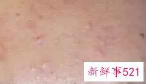 怎么才能不长痘痘粉刺