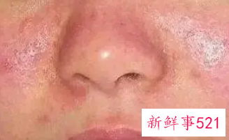 身体皮肤角质层薄怎么修复