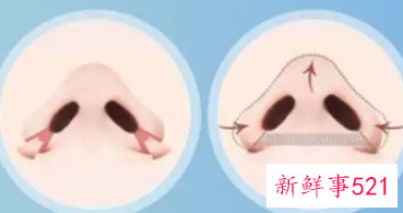 如何使鼻翼变小