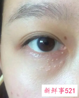 眼周围有脂肪粒怎么去除比较好