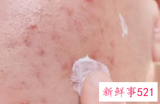 怎么才能不长痘痘粉刺