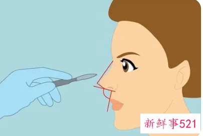 耳软骨隆鼻好不好