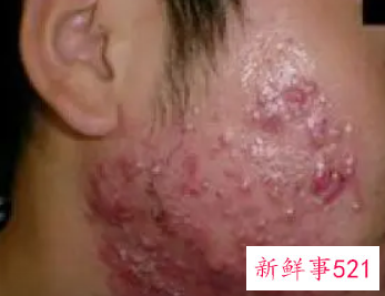 孩子青春痘过多怎么治