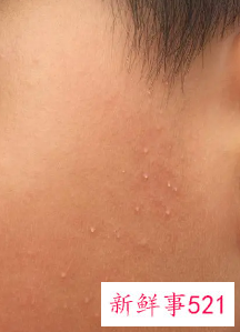 脸上起来了好多小米粒