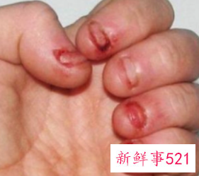 孩子爱咬手指甲是什么原因