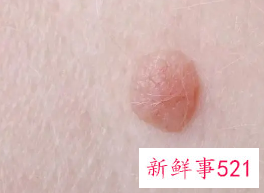 去瘊子最快的方法