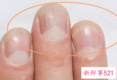 营养指甲的维生素