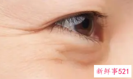 激光去除鱼尾纹有什么优势