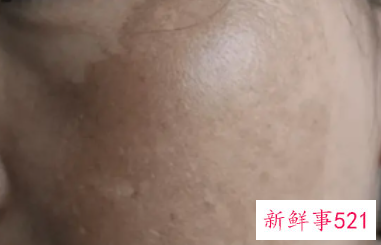 怎么去除蝴蝶斑