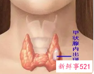 为什么生完孩子甲状腺有问题