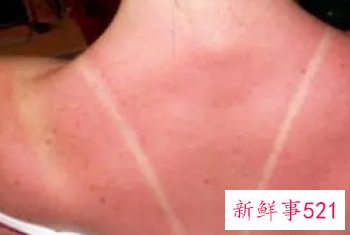 身体暴晒修复方法