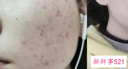 冬季轻松祛痘应该怎么做