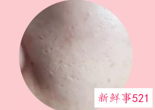 毛孔大真的缩不回来