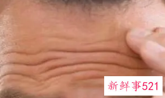 抬头纹有什么办法可以消除