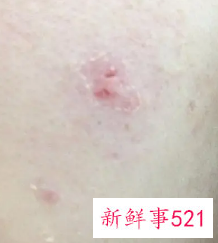 痘痘里有白色的脓包