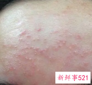 过敏皮肤变红怎么消退