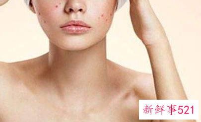 冬季轻松祛痘应该怎么做