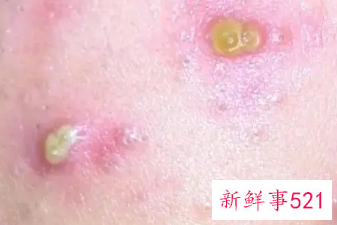 痘痘里有白色的脓包