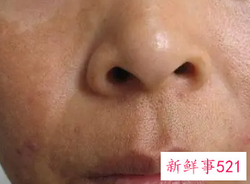 怎样改善鸡皮肤褐色斑点