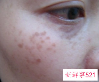 长斑了可以怎么淡化