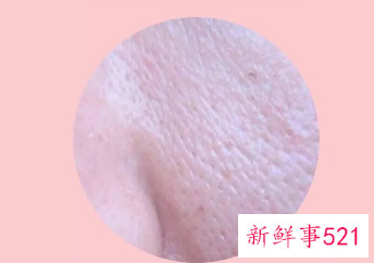 毛孔大真的缩不回来