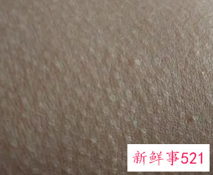 异性碰我就起鸡皮疙瘩