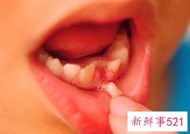 儿童一般几岁换牙乳牙