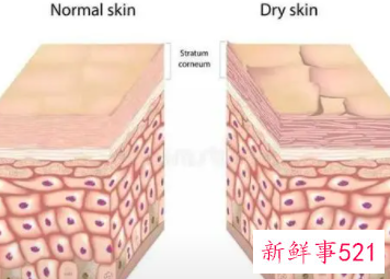 干性皮肤怎么造成的