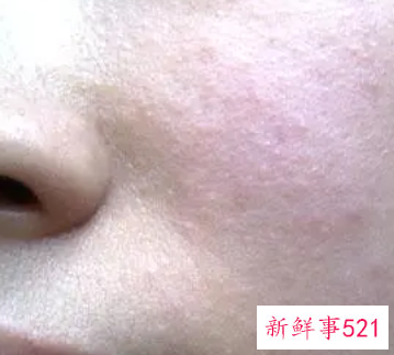 面部皮肤过敏发红怎么办