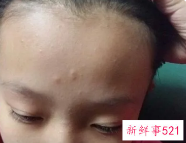 孩子青春痘过多怎么治