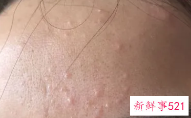 脸上起来了好多小米粒