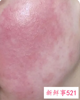 过敏皮肤变红怎么消退