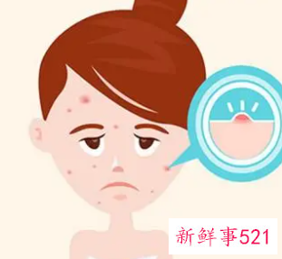 补水可以祛痘印吗