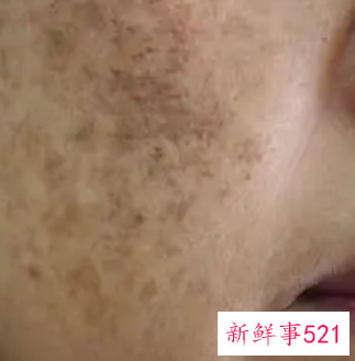怎么去除蝴蝶斑