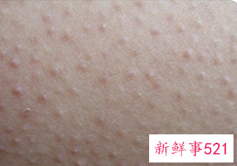 梦见腿上长好多疙瘩