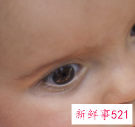 小孩眨眼睛缺维生素b