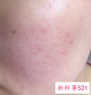 面部皮肤过敏发红怎么办