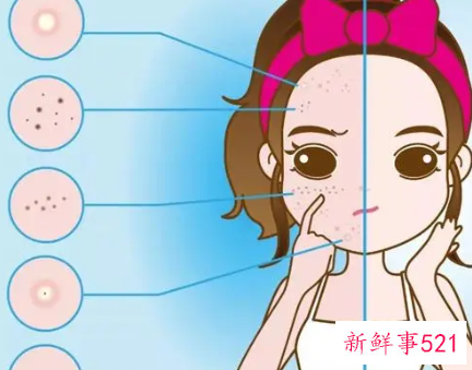 激光祛斑好还是药水点斑好